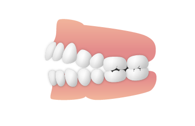 上下の歯の間が開いている