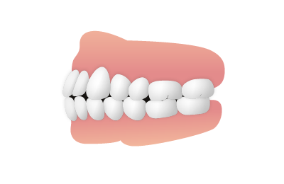 上下の前歯の先端同士がぶつかってる
