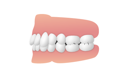 上の前歯が下の前歯に咬み合わさっている