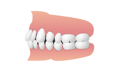 歯と歯の間に隙間が出来ている