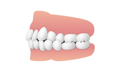 奥歯または前歯が横にずれている