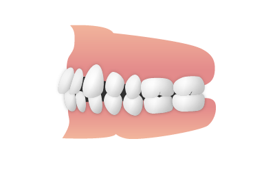 空隙歯列（くうげきしれつ）